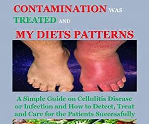 A Simple Guide To Cellulitis, Diagnosis, Treatment And Related Conditions (A Simple Guide to Medical Conditions) A Simple Guide To Cellulitis, Diagnosis, Treatment And Related Conditions (A Simple Guide to Medical Conditions)