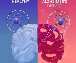 Alzheimer's Disease and Memory Loss Explained: A Guide for Patients and Carers