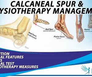Calcaneal Spur Management: How to Treat A Calcaneal Spur Naturally and Get Quick Relief from Foot Pain