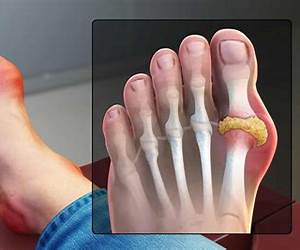 GOUT FREE: Beat Gout with Diet and Lifestyle Changes and Live Life Gout Free!