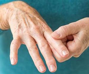Living With Rheumatoid Arthritis