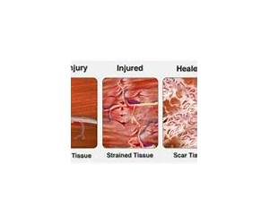 Scar Tissue