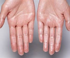 Sweaty Hands: How to Treat Hyperhidrosis